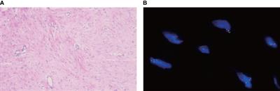 Combination of Anlotinib and Celecoxib for the Treatment of Abdominal Desmoid Tumor: A Case Report and Literature Review